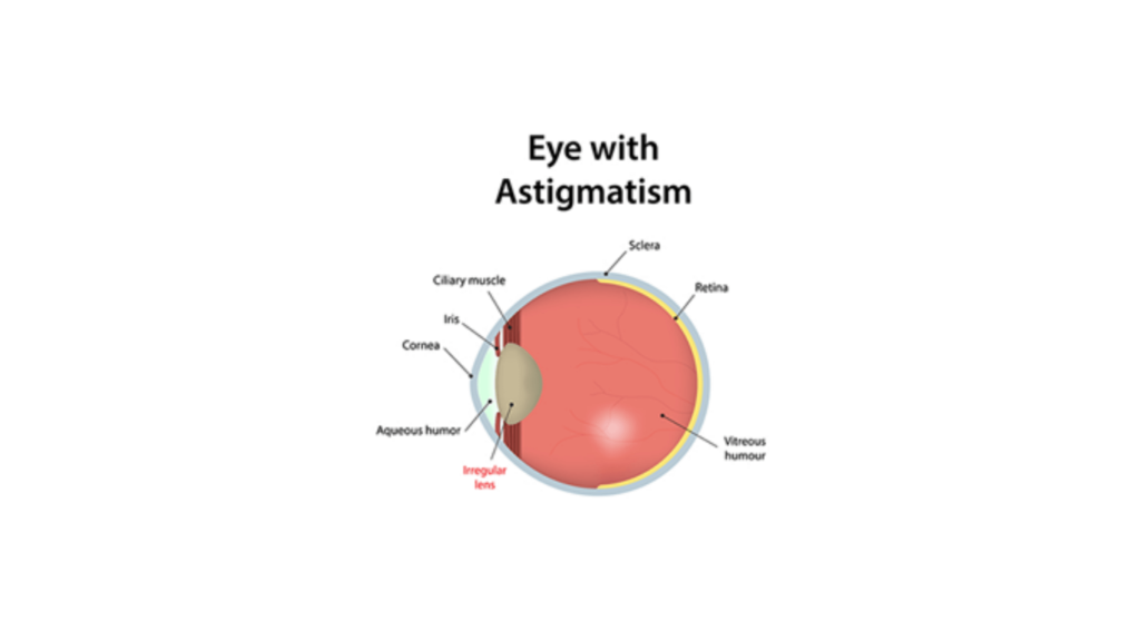 Can You Cure Astigmatism Naturally